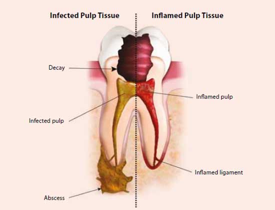 Dental Pulp Infection